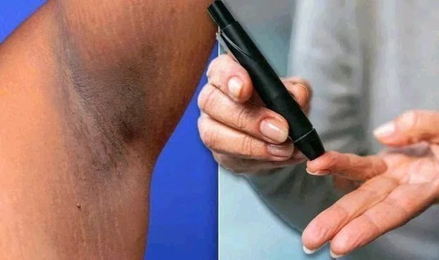 6 Warning Signs Your Blood Sugar Is Too High — Don’t Ignore Them