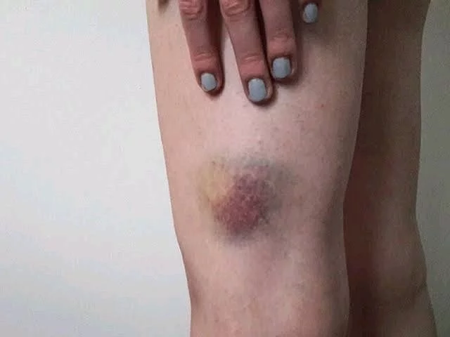 6 Early Warning Signs of Cancer You Should Never Ignore