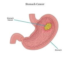 Stomach Cancer Risk: Three Dietary Habits Linked to Faster Disease Progression